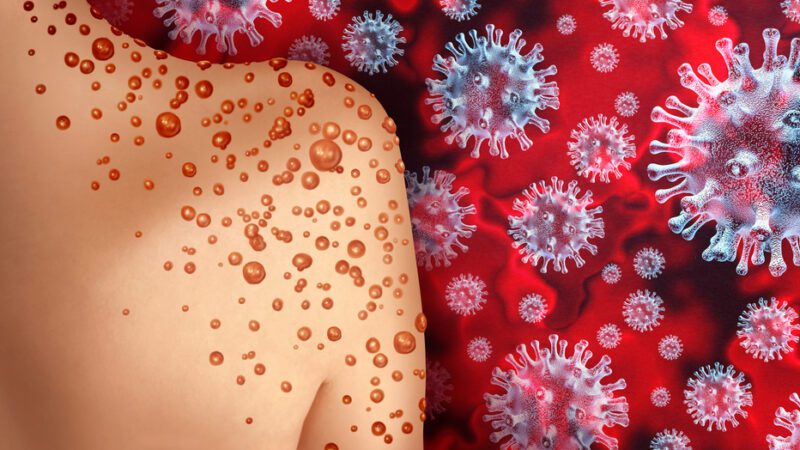 China’s First Monkeypox Outbreak Investigated in Shenzhen