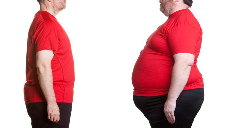 Weight loss surgery showing promising results for type 2 diabetes