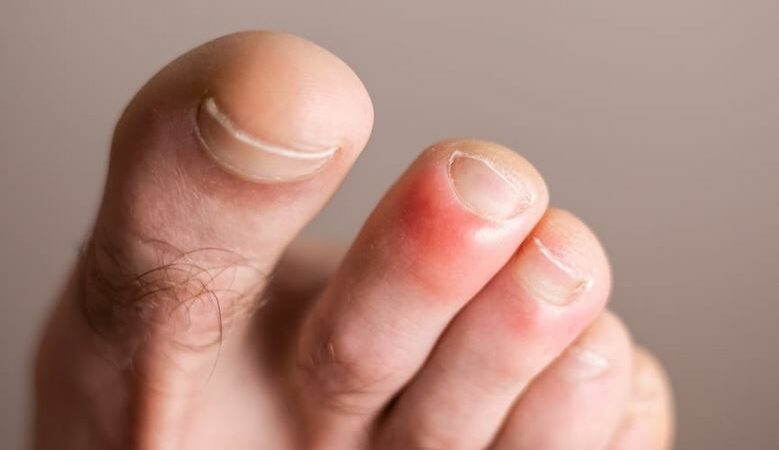 Study supports link between COVID-19 and “COVID Toes”