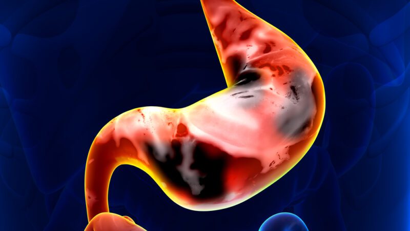 Gastrointestinal Adverse Events in Patients Taking GLP-1 Agonists for Weight Loss